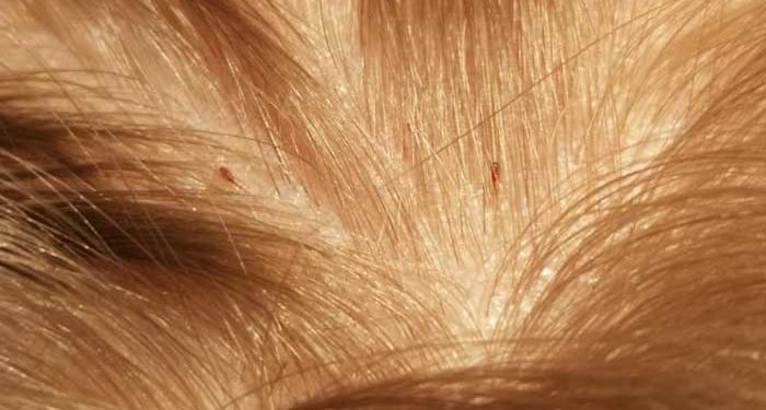 4 Tips Hilangkan Kutu Rambut secara Alami – Islampos