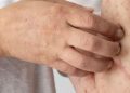 Herpes: Penyebab, Jenis, Gejala, Pengobatan, dan Pencegahan 1