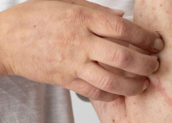 Herpes: Penyebab, Jenis, Gejala, Pengobatan, dan Pencegahan 1 Herpes